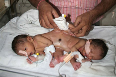 Индийские хирурги разделят сиамских близнецов с общими органами