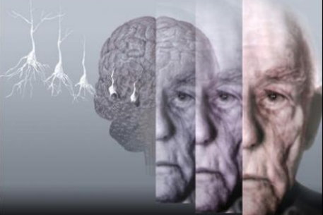Альцгеймер отбирает у мировой экономики 1% ВВП