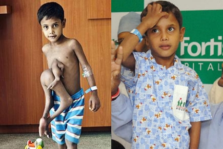 Индийские медики прооперировали мальчика с восемью конечностями
