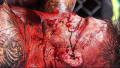 Топовый боец UFC показал последствия заражения стафилококковой инфекцией