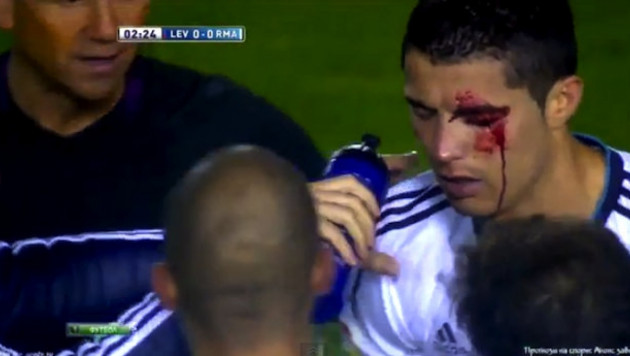 ВИДЕО: Роналду потерял зрение из-за травмы в матче чемпионата Испании