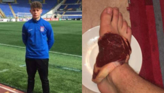 Футболист выдал себя за физиотерапевта и заставил одноклубника лечить травму куском мяса