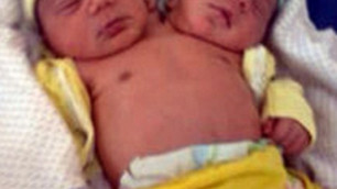 Двухголовый ребенок родился в Бразилии