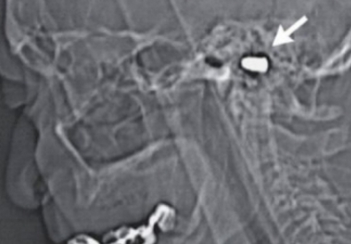 Рентгеновский снимок головы с пулей. Фото с сайта nejm.org