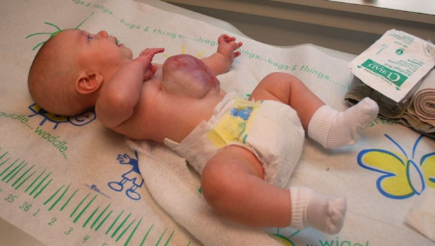 Врачи прооперировали родившегося с органами наружу малыша