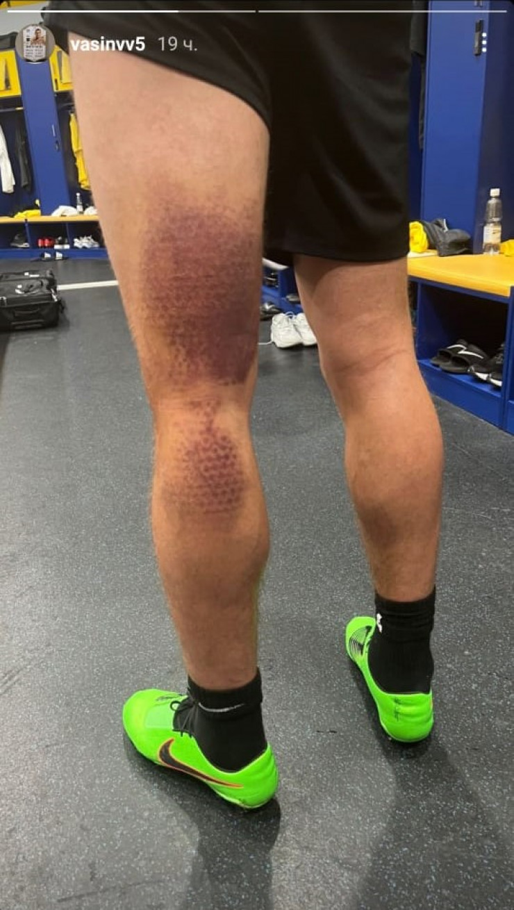Защитник "Кайрата" показал страшное повреждение перед матчем с "Астаной". Фото 1
